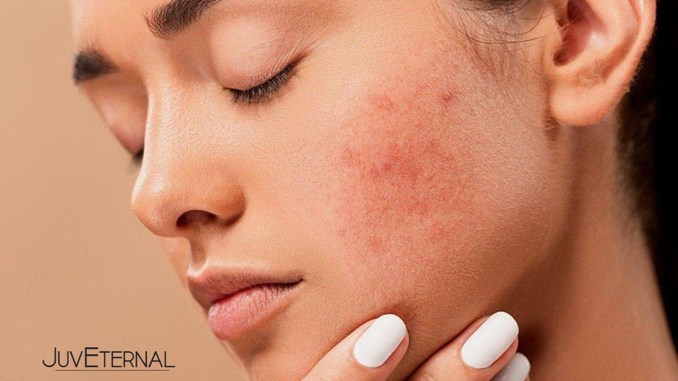 ¿Qué suplementos e ingredientes activos en productos de skincare ayudan a combatir el acné  y mejorar la textura de la piel?