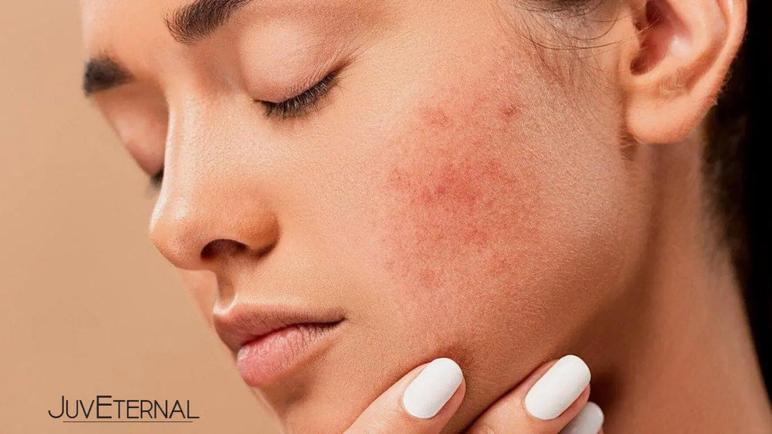 ¿Qué suplementos e ingredientes activos en productos de skincare ayudan a combatir el acné  y mejorar la textura de la piel? Juveternal